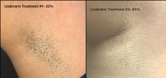 Underarm Hair Removal